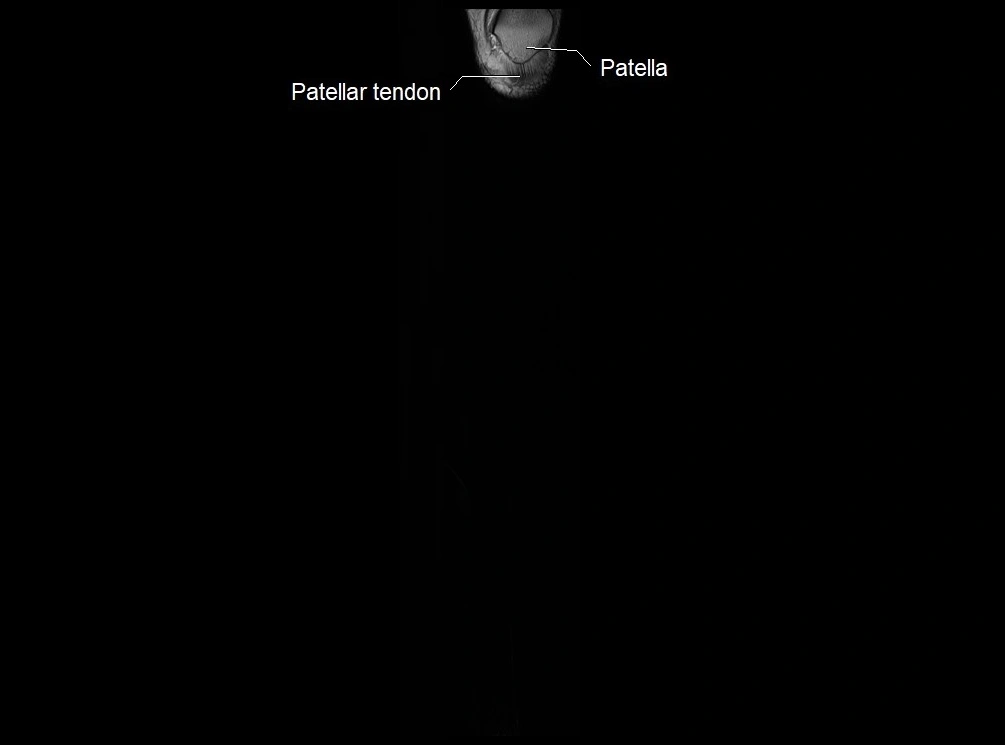 MRI 3T leg (tibia & fibula) labelled coronal cross sectional anatomy image 1.webp